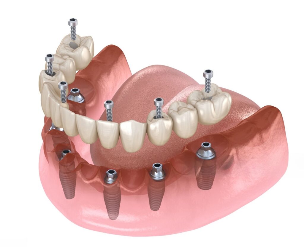 implantes imagen sobre una prótesis colocada sobre un implante